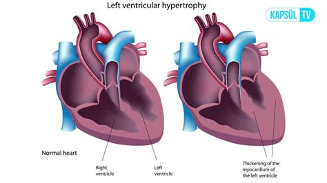 aort yetmezliği hipertansiyon